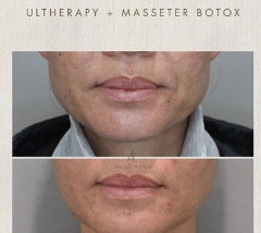 Lower face profile before and after comparison for Ultherapy and masseter Botox treatments