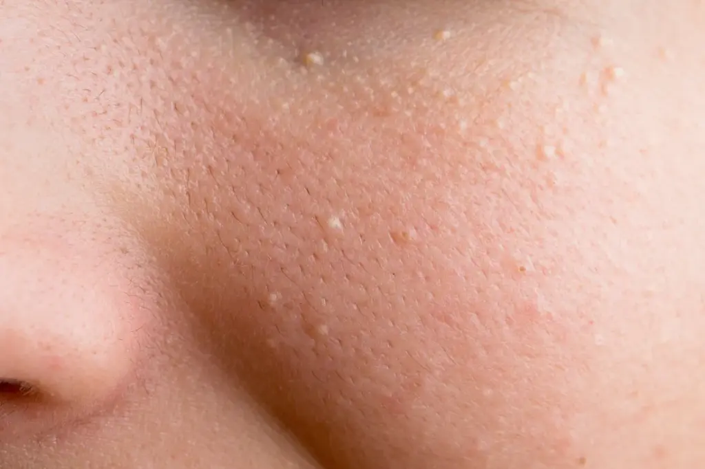 Macro close-up view of skin texture showing small white milia bumps