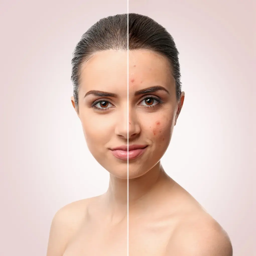 Split before-and-after comparison showing facial acne reduction following active acne treatment