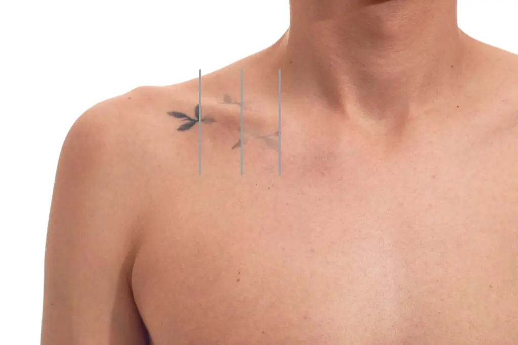Close-up of a delicate neck tattoo being evaluated before laser tattoo removal